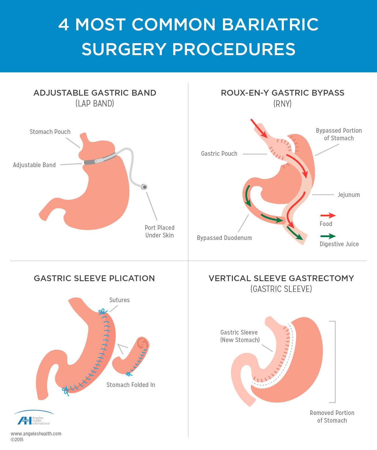 Top 90 Pictures Pictures Of Bariatric Surgery Latest