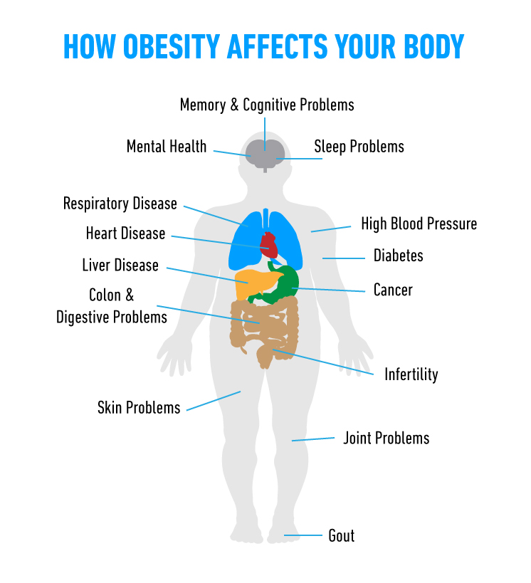 How Obesity Affects Your Body Angeles Health Mexico 