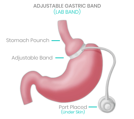 Lap Band Price With Insurance Miami Gastric Band Surgery